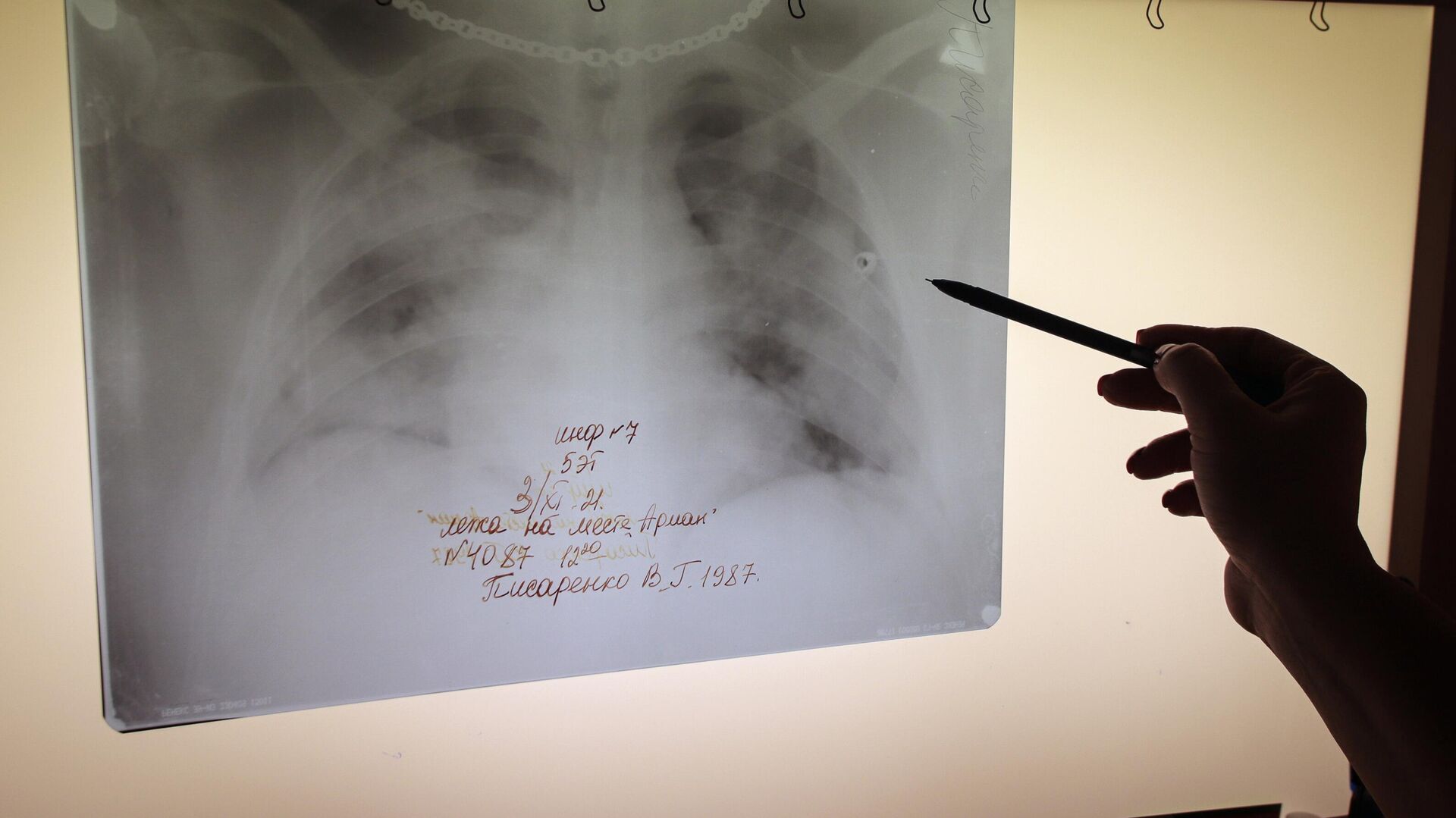 Медицинский работник изучает рентгеновский снимок легких пациента - rnews, 1920, 18.09.2023