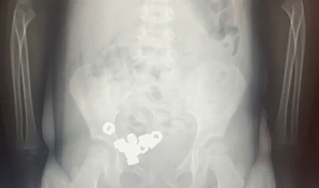 В Воронеже медики рассказали о 16 проглоченных трёхлетним ребёнком гайках - Новости Воронежа, 17.11.2025