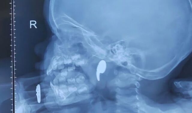 Магнит застрял в носоглотке 1,5-годовалой девочки: воронежские врачи спасли ребёнка - Новости Воронежа, 26.03.2026