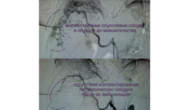 Воронежские врачи спасли пациентку с опухолью, занявшей почти всю печень - Новости Воронежа, 20.04.2026