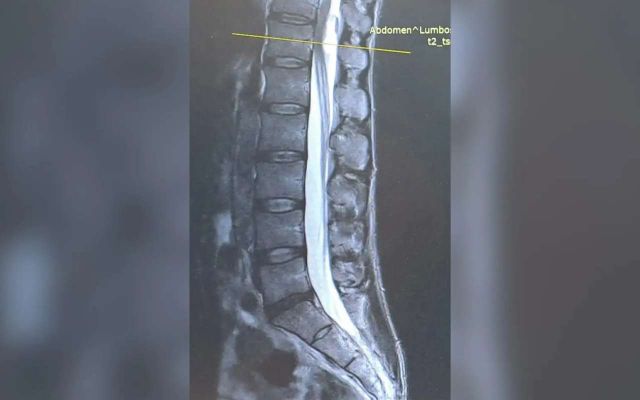 От опухоли спинного мозга спасли пациента воронежские хирурги - Обозреватель.Врн, 25.06.2026