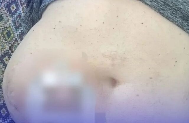 «Боди-хоррор»: житель Приморья жил с 20-сантиметровой грыжей в животе - PRIMPRESS, 08.06.2026