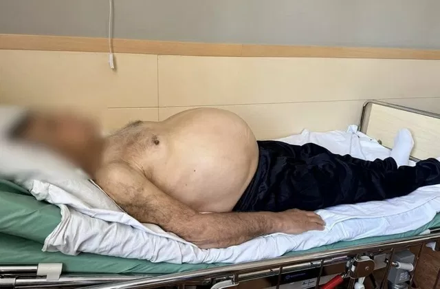 Пенсионер из Ростовской области выжил после удаления опухоли весом 15 кг - Новости Ростова-на-Дону - последние новости Ростова-на-Дону сегодня на 1rnd.ru, 25.06.2026