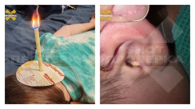 Любителям самолечения на заметку: популярные ушные фитосвечи могут привести к глухоте - ИА Амител, 04.11.2025