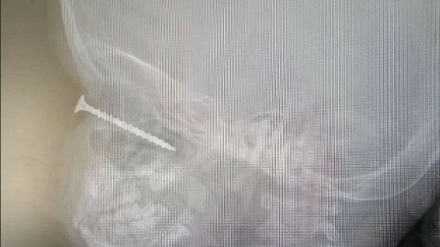 Врачи спасли глаз и зрение мальчику, которому в глазницу вошел саморез Врачи спасли глаз и зрение мальчику, которому в глазницу вошел саморез - ИА Амител, 12.10.2026