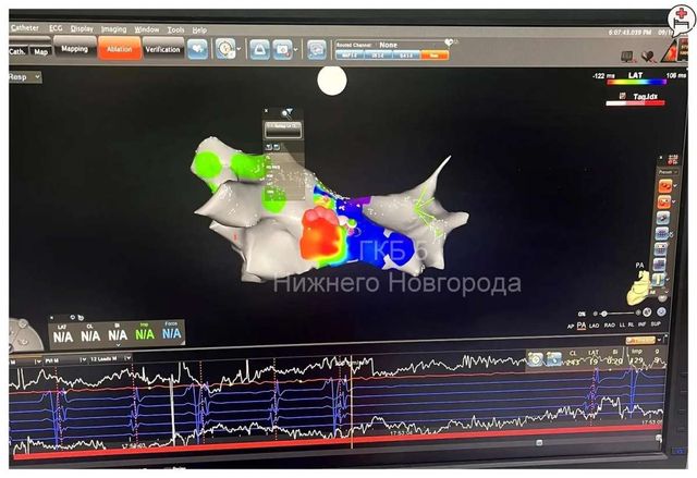 Нижегородские врачи вернули к нормальной жизни пациента с опасной аритмией - НИА Нижний Новгород, 22.09.2026