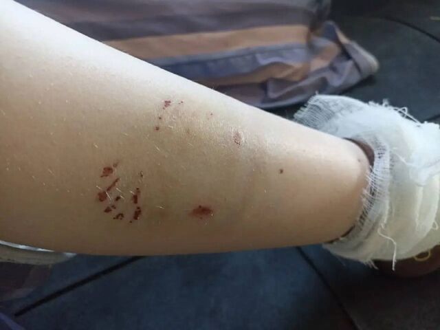 В Алейске от укуса бездомной собаки пострадала школьница. - Барнаул №1, 22.04.2026