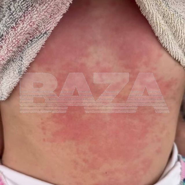Морские блохи напали на отдыхающих на Азовском море. У детей после купания появляются сильный зуд и сыпь. - Краснодар и край, 28.06.2026